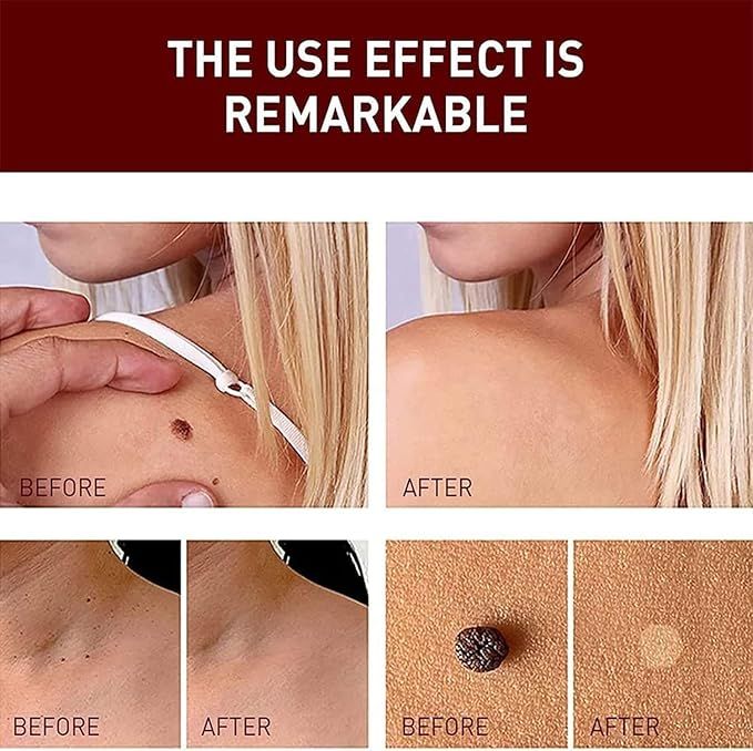 Face and Body Mole Remover